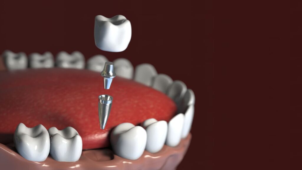 Titanium dental implants