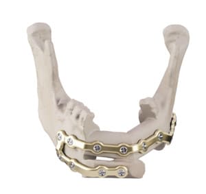 Craniofacial and Maxillofacial Implants